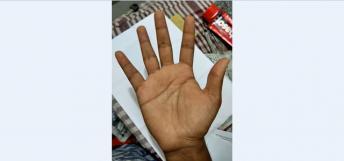 Overlapped Life Line