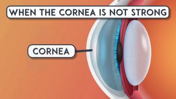 What is Keratoconus