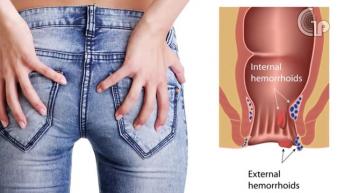 बवासीर का रामबाण उपचार | बवासीर होने पर क्या घरेलु उपचार करे | Piles Treatment | Healthy Remedy