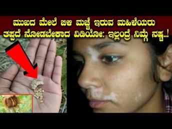 ಮುಖದ ಮೇಲೆ ಬಿಳಿ ಮಚ್ಚೆ ಇರುವ ಮಹಿಳೆಯರು ತಪ್ಪದೆ ನೋಡಬೇಕಾದ ವಿಡಿಯೋ: ಇಲ್ಲಂದ್ರೆ ನಿಮ್ಗೆ ನಷ್ಟ..!