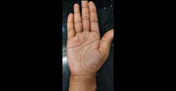 Progress Lines and Medical Stigmata