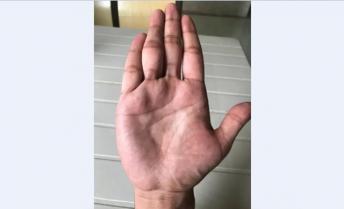 Weak Mercury Line Can Give Health Problems