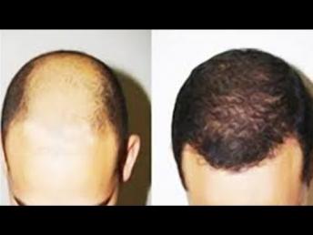 How to regrow hair on your head | Bald Head tips in Kannada | Nanna Arogya